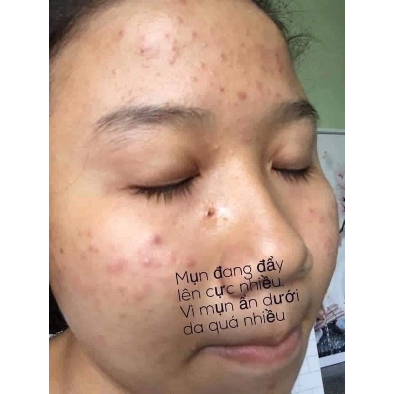 COMBO LINH CHI VI MỤN VÀ MASK HOA HỒNG THANH TRANG