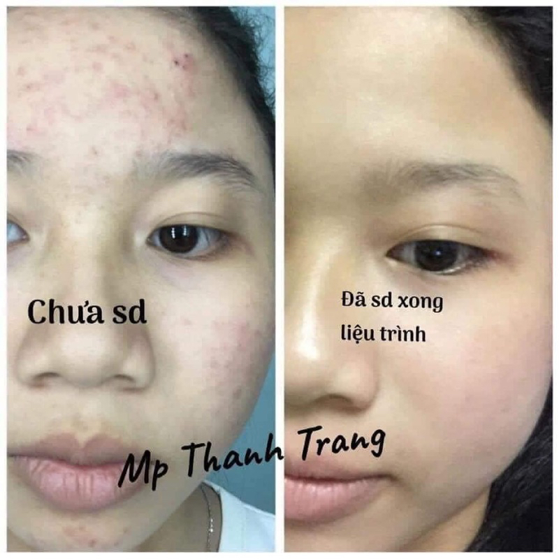 COMBO LINH CHI VI MỤN VÀ MASK HOA HỒNG THANH TRANG