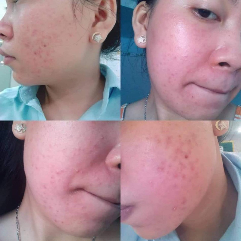 SERUM NỌC RẮN