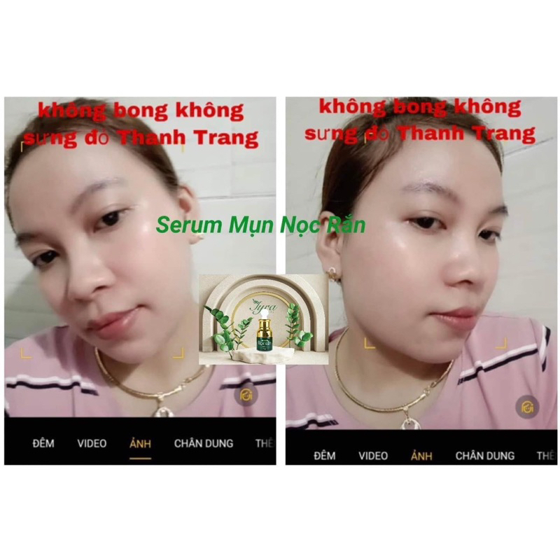 SERUM NỌC RẮN