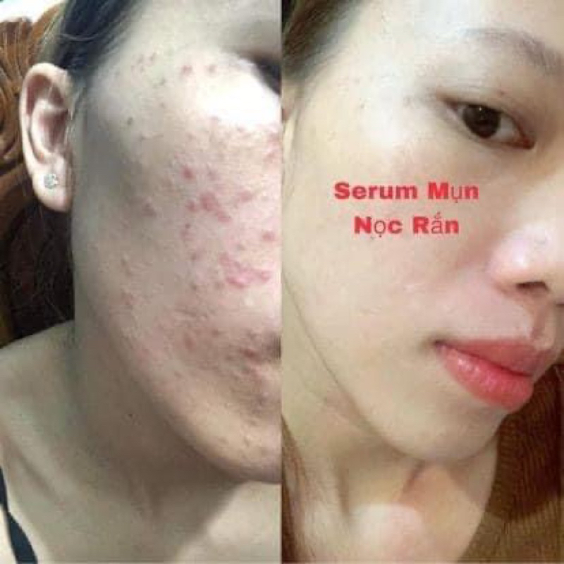 SERUM NỌC RẮN