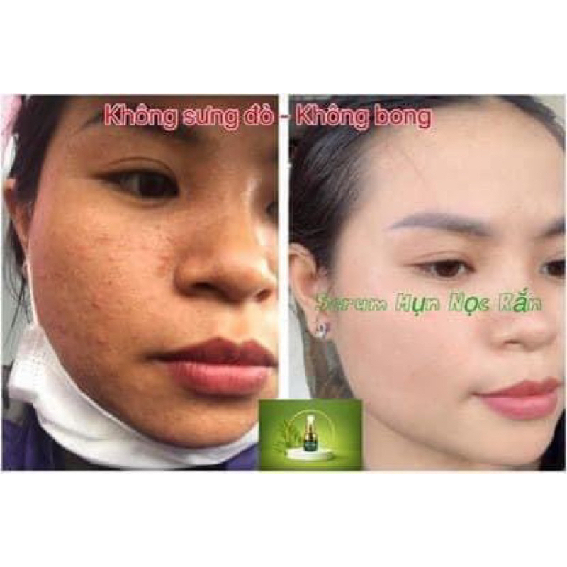 SERUM NỌC RẮN