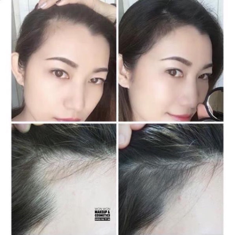 Chấm che hói, che chân tóc Maycher