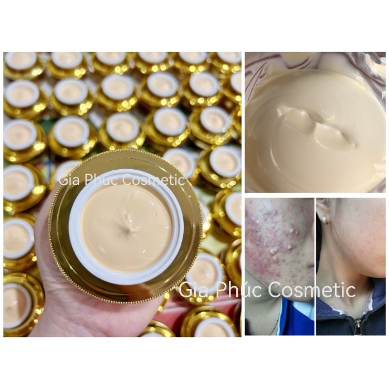 Kem Mụn Tr.ị Dứt Điểm ¦ Đầu Đen ¦ Trứng Cá ¦ Thâm Mụn