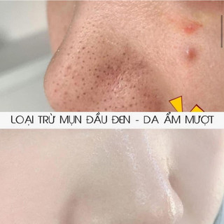 BHA blackhead giảm mụn đầu đen