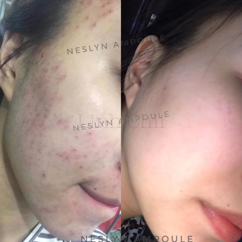 Serum tràm trà, gom cồi mụn, ngừa thâm NesLyn AMPOULE chính hãng