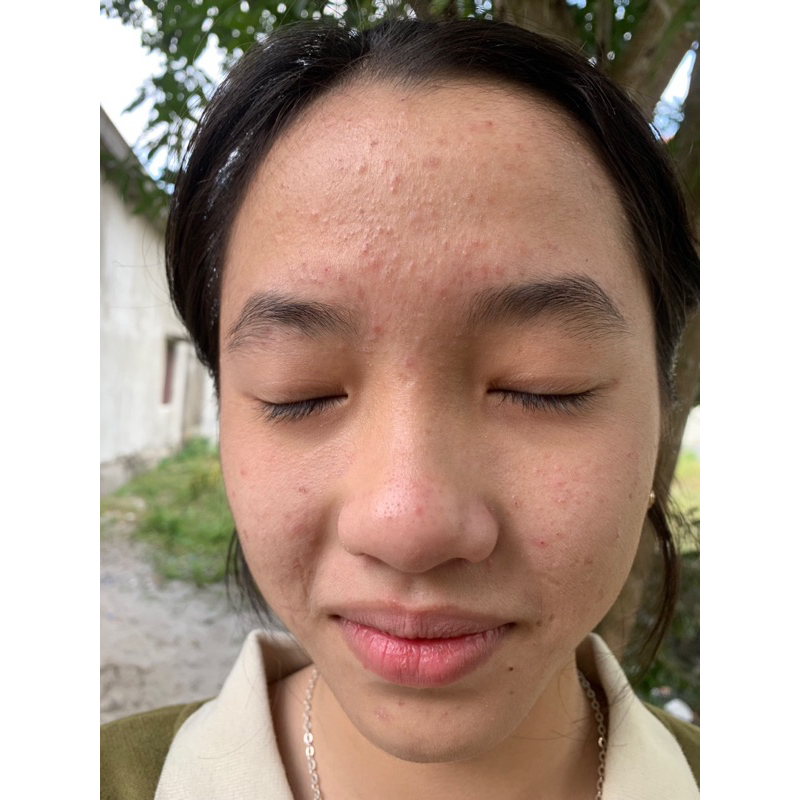 Serum tràm trà, gom cồi mụn, ngừa thâm NesLyn AMPOULE chính hãng