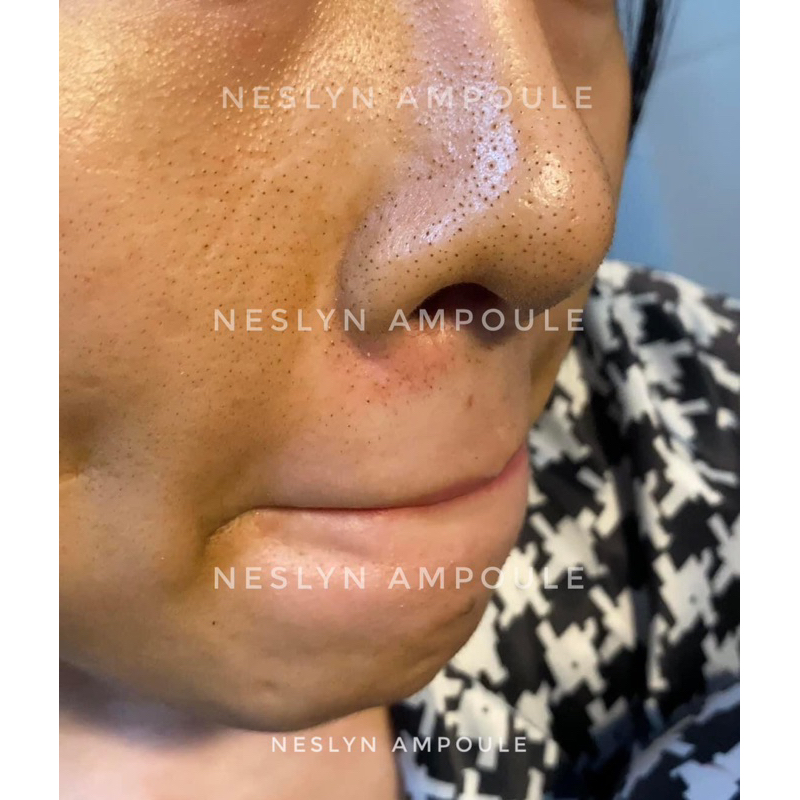 Serum tràm trà, gom cồi mụn, ngừa thâm NesLyn AMPOULE chính hãng