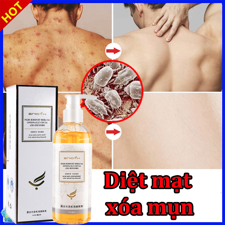 Sữa tắm kháng khuẩn Sữa tắm trắng da 260ML loại bỏ các bệnh viêm nang lông mụn lưng,mụn ở ngực Cải thiện làn da thô ráp
