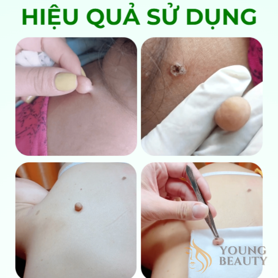 Kem mụn thịt dư OINTMENT - Kem rụng mụn thịt, u thịt lâu năm, giúp da láng mịn hơn - YOUNG BEAUTY