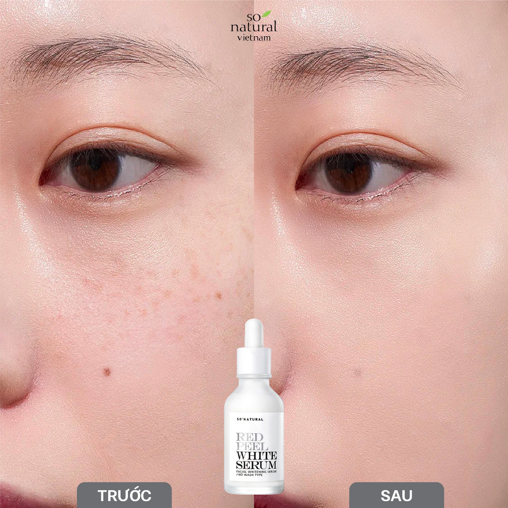 Red Peel White Serum 35ml Niacinamine 5%Tinh Chất Giảm Nám, Dưỡng Trắng Da chính Hãng So Natural