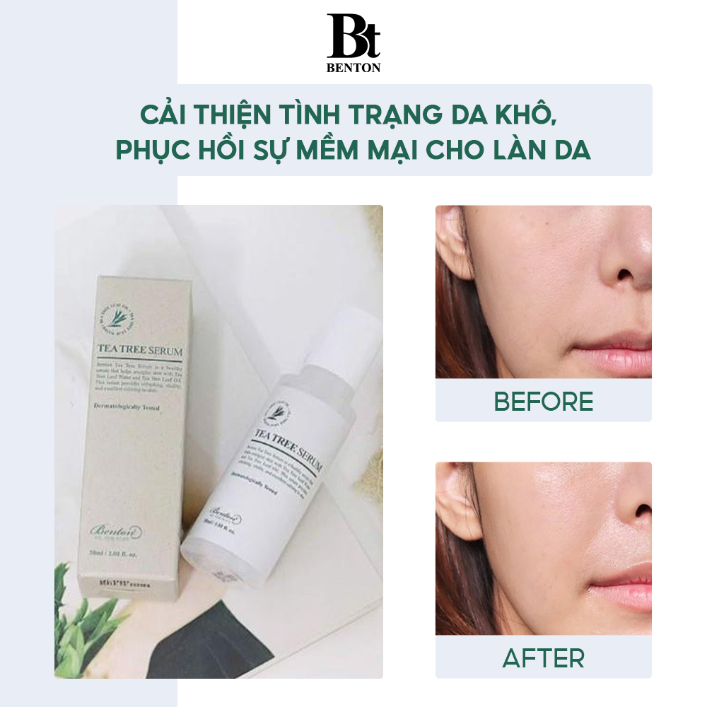 Tinh chất hỗ trợ giảm mụn Benton Tea Tree Serum