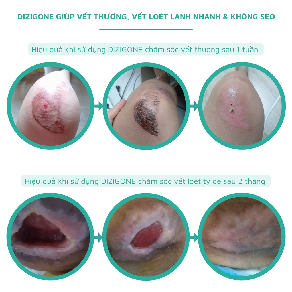 Combo Chăm Sóc Thủy Đậu, Tay Chân Miệng nhanh chóng Dung dịch kháng khuẩn DIZIGONE 300ml & Kem DIZIGONE Nano Bạc 25g