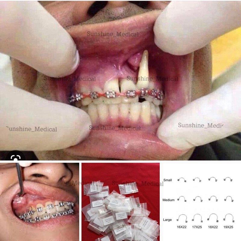 Torque chỉnh nha chống lòi chóp lò xo waren torque art hỗ trợ chỉnh nha TT9