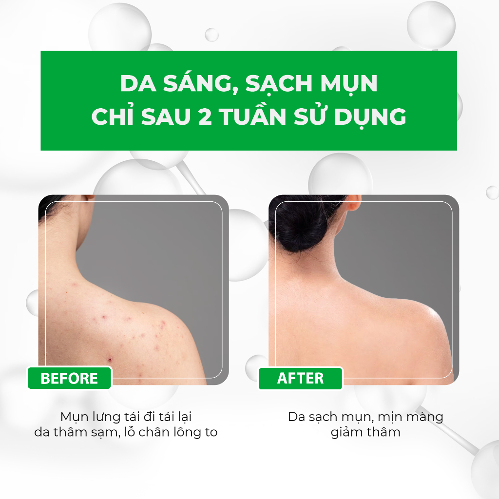 Sữa Tắm Hỗ Trợ Giảm Mụn Giảm Viêm Chân Lông Acnevir Santafa Chai 210ml | BigBuy360 - bigbuy360.vn