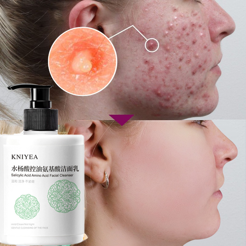 Sữa rửa mặt trắng da sữa rửa mặt kiểm soát dầu nước cân bằng da salicylic acid máy hút mụn đầu đen