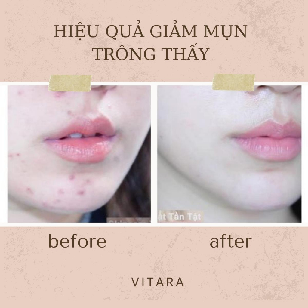 Kem chấm mụn Tretinoin Vitara Acnetin A dưỡng trẻ hóa da Thái Lan hỗ trợ giảm mụn ẩn mụn thâm tuýp 10g