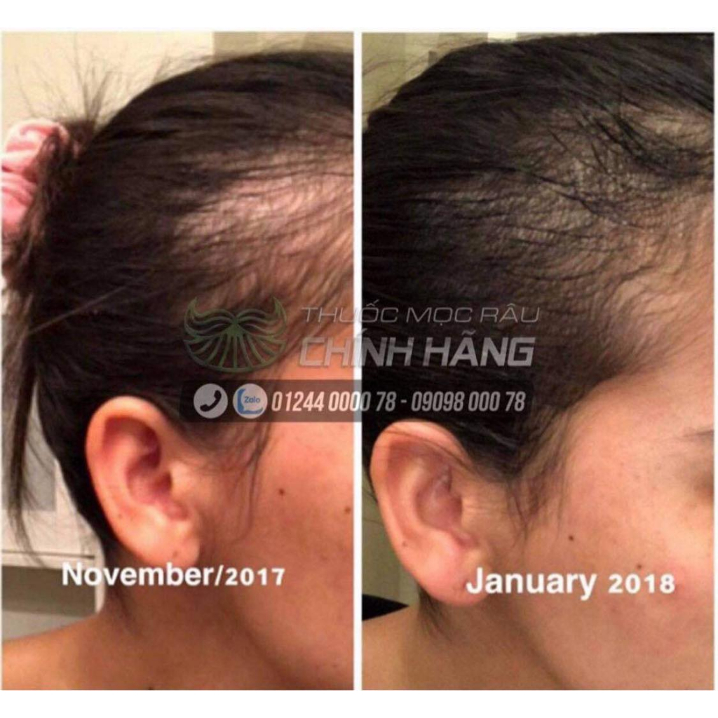 DHT Blocker HairOmega