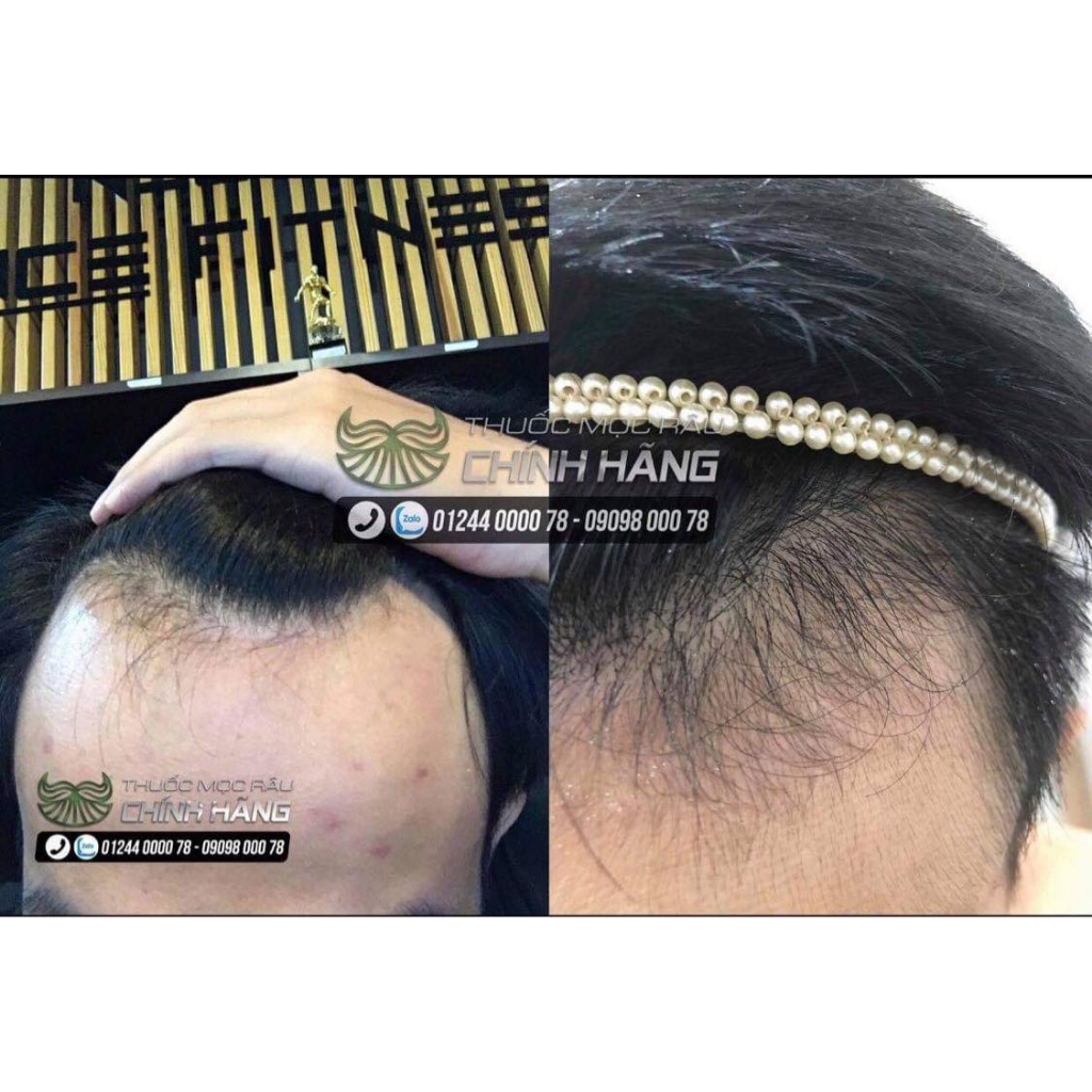 DHT Blocker HairOmega