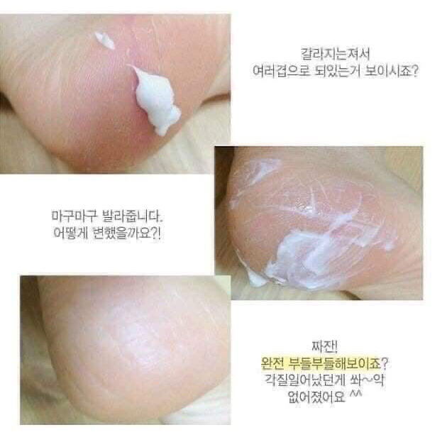 Kem nứt gót chân Urea Hanmi Hàn Quốc 50g. Giải pháp cho làn da nứt nẻ