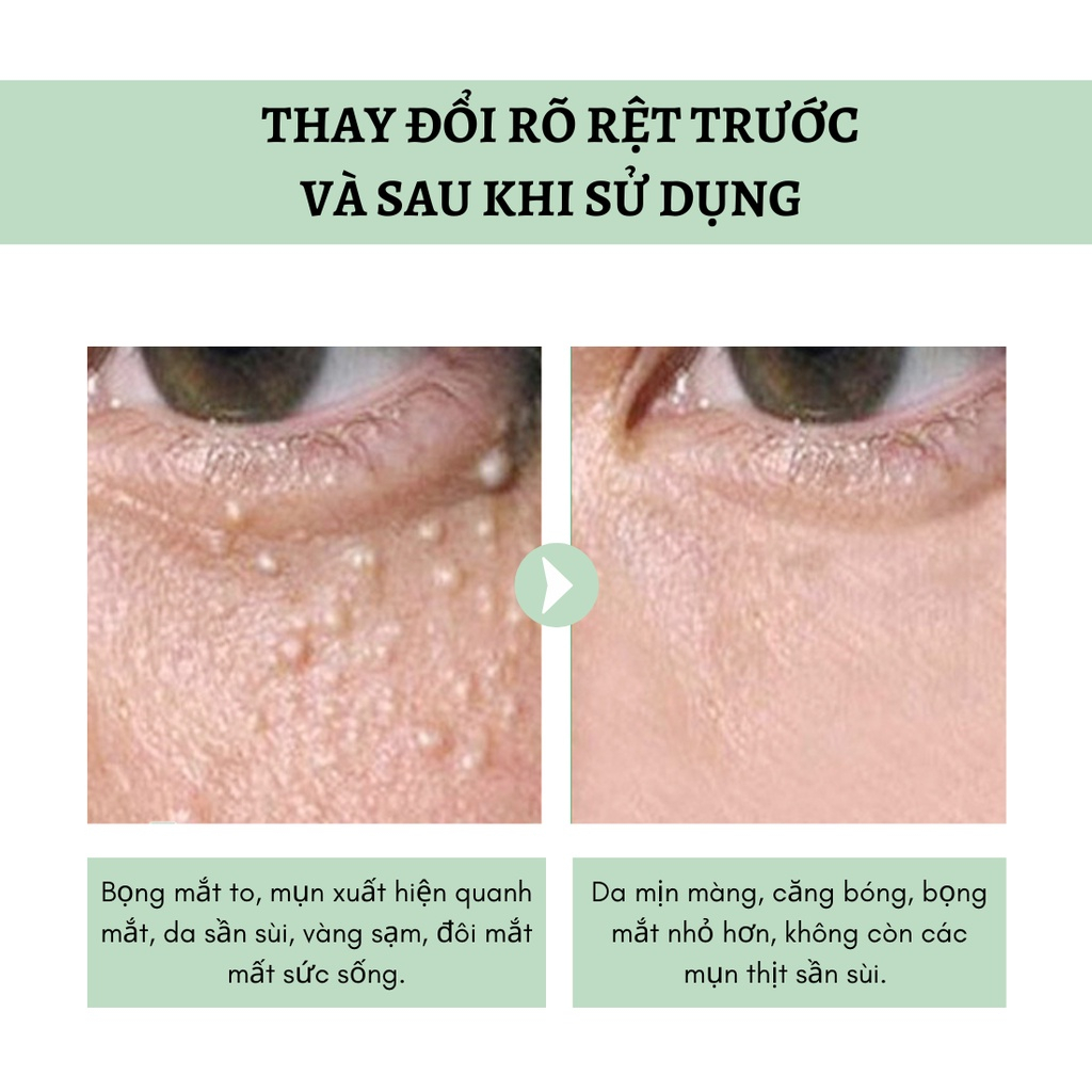 Kem Bơ Giảm Mụn Thịt , Quầng Thâm Mắt