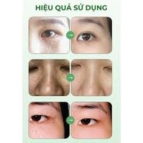 Kem mụn thịt mắt bơ Yaquinuo ( Auth )