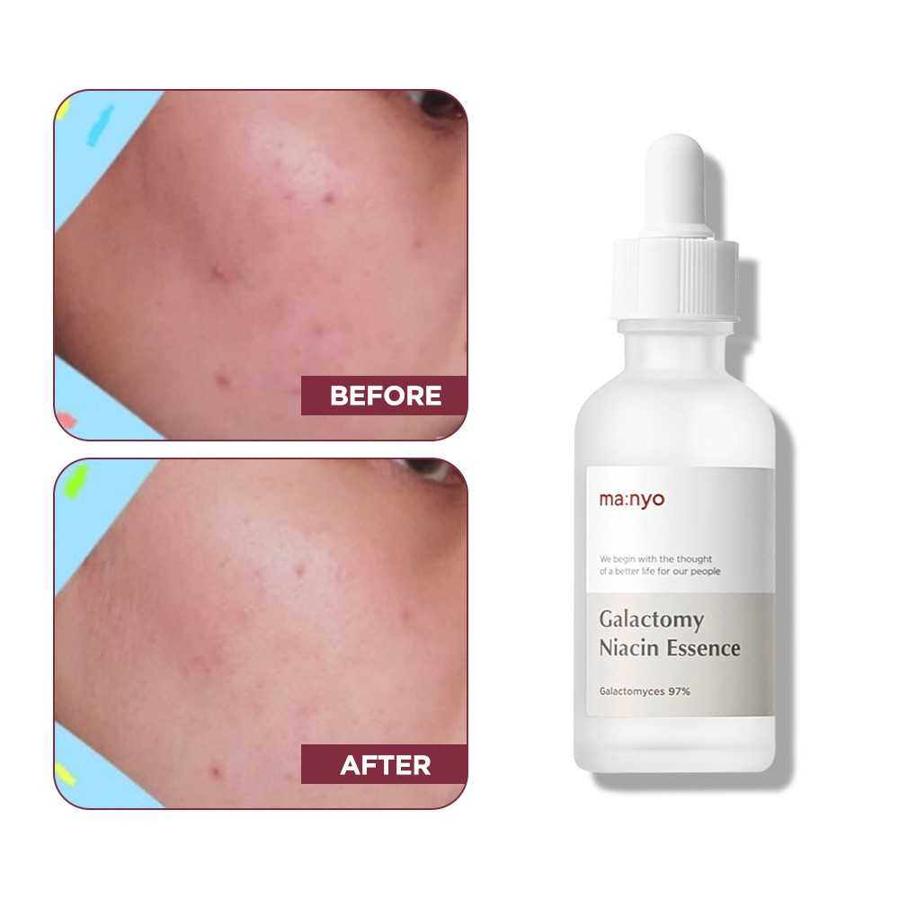 Tinh Chất Dưỡng Trắng Manyo Galactomy Niacin Essence 50ml/8ML MA:NYO