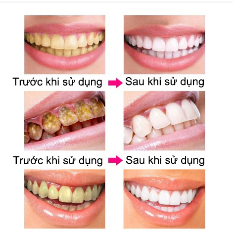 Kem đánh răng trắng răng Viên đánh trắng răng Hũ 30 viên sạch mảng bám ngừa sâu răng Cấp tốc Tẩy cao răng