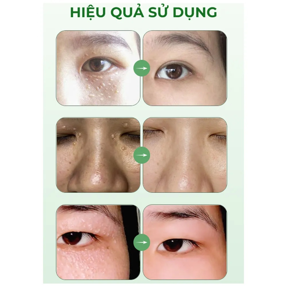 Kem bôi mụn thịt vùng mắt khô rụng tự nhiên