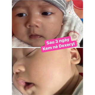 KEM NẺ DEXERYL PHÁP - CHÀM VIÊM DA CƠ ĐỊA
