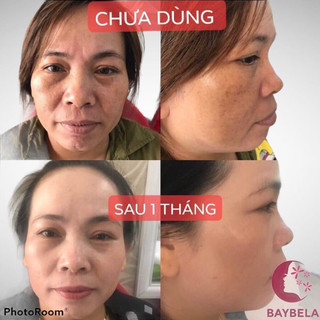 kem dưỡng nám số 3 (baybela)