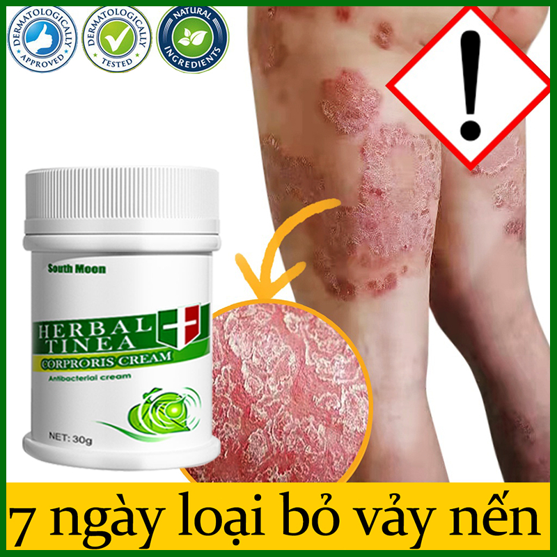 Kem bôi nấm ngứa da toàn thân HERBAL TINEA CORPORIS CREAM tái tạo phục hồi dưỡng ẩm da vùng nấm -30gr