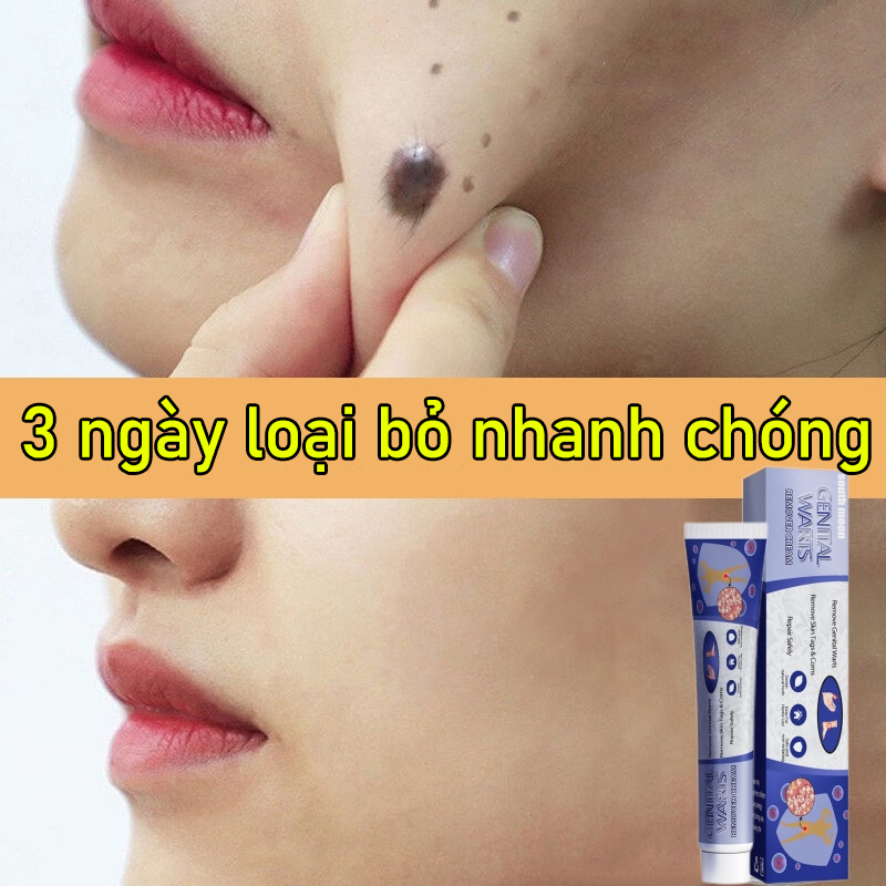 Kem loại bỏ mụn cóc.Kem Hỗ Trợ Giảm Mụn Cóc Nốt Ruồi Và Đốm Nâu Chính Hãng, sâu phù hợp cho unisex