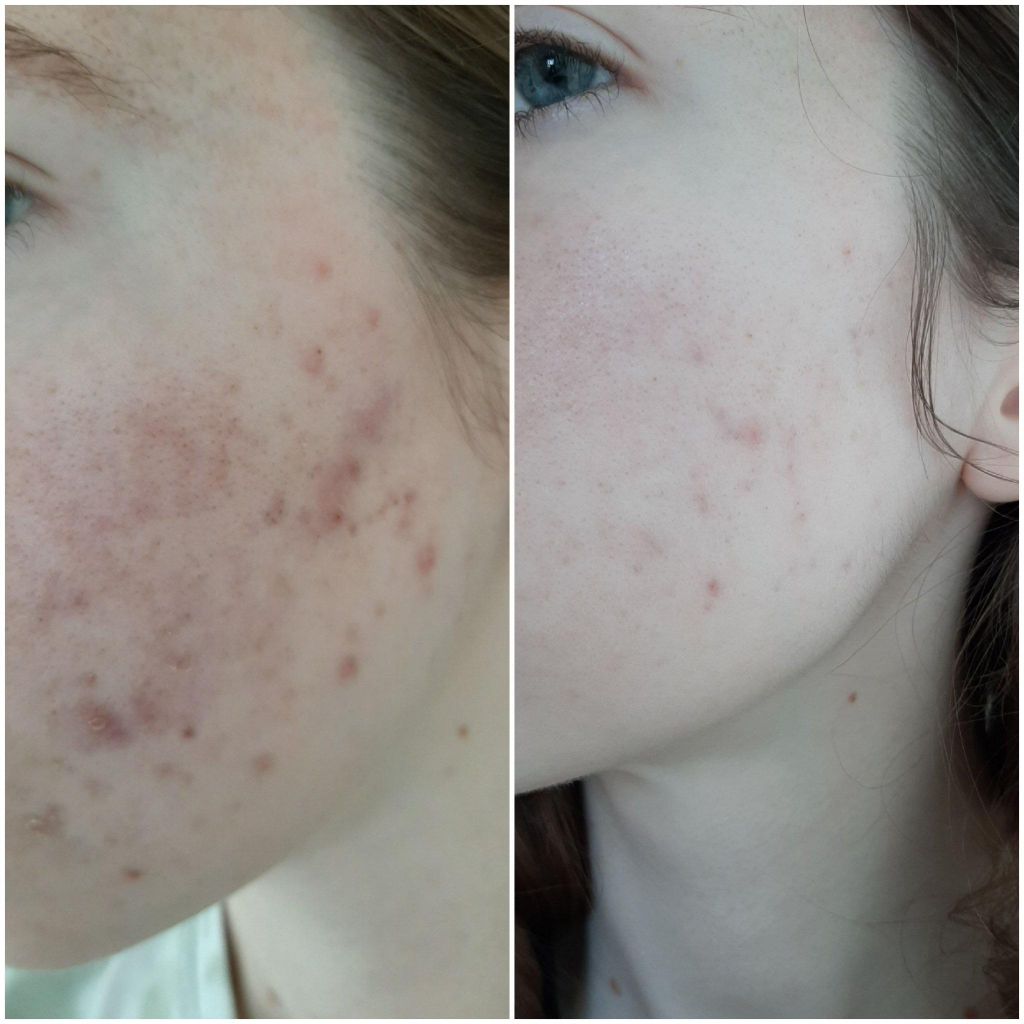 Serum tẩy tế bào chết The Ordinary AHA 30% + BHA 2% Peeling Solution