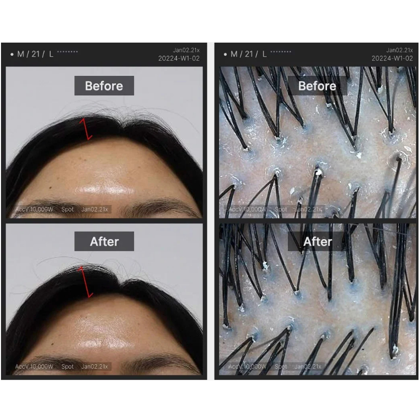 Set Làm sạch gàu giảm mụn MEDICUBE