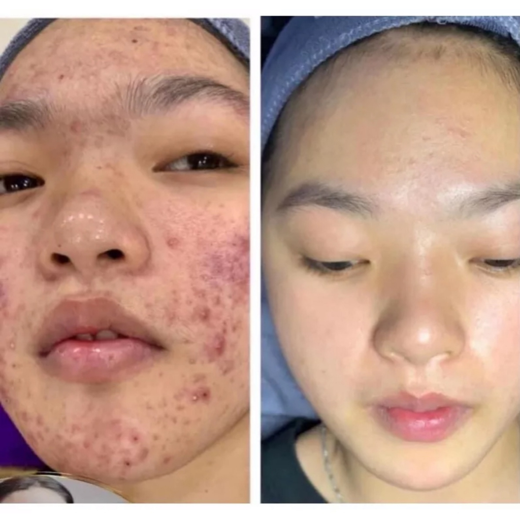 Huyết thanh đặc tri mụn đầu đen cho Spa dung tích 10ml