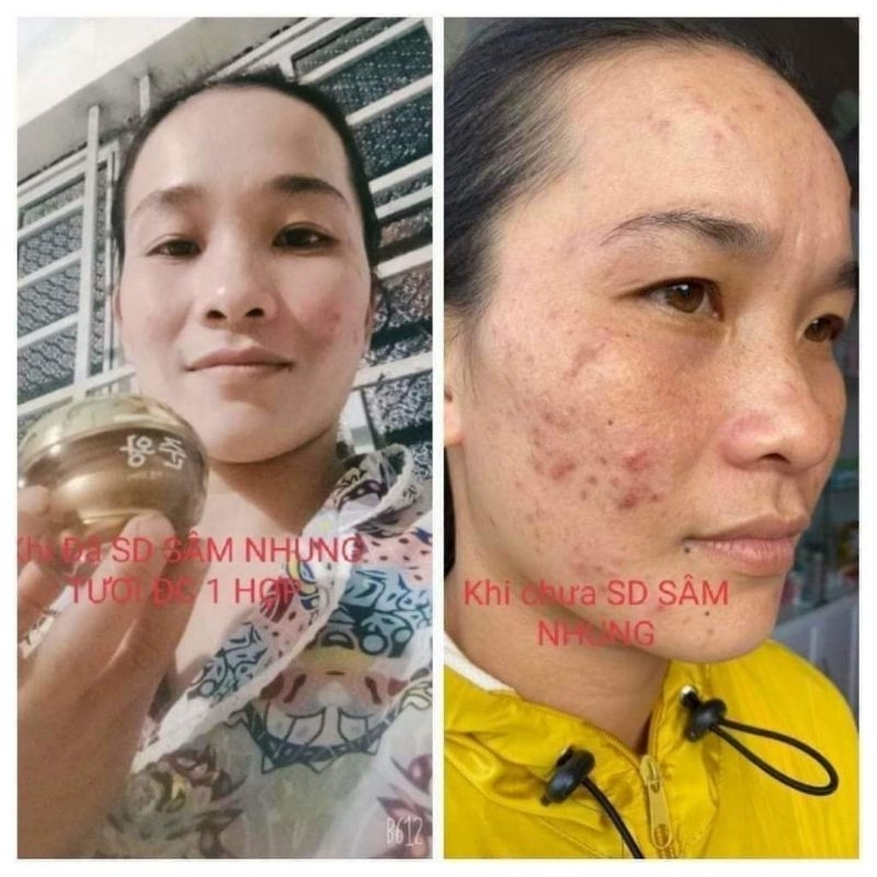 KEM SÂM NHUNG TƯƠI TẶNG KÈM 2 CHAI SERUM GIẢM NÁM, TÀN NHANG, NGĂN NGỪA LÃO HÓA DA