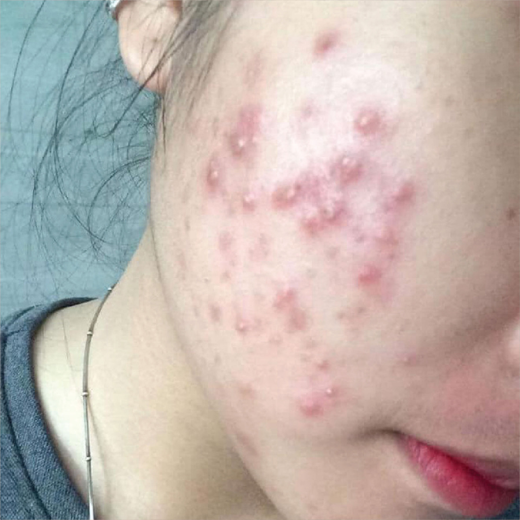 Cao lá nam - Huyết Thanh - Cao Lá Nam Ngừa Mụn - Cao Lá Nam Mix Saffaron 10ml