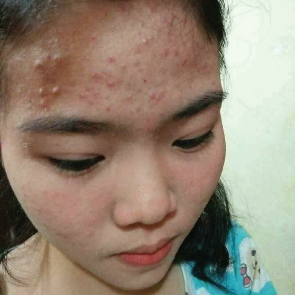Cao lá nam - Huyết Thanh - Cao Lá Nam Ngừa Mụn - Cao Lá Nam Mix Saffaron 10ml