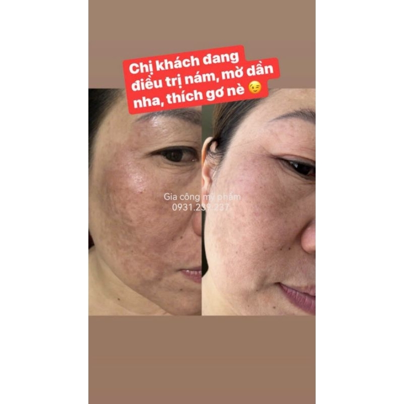 Kem  Nhung Hươu | Trắng Sáng Da | Giảm Thâm mụn | Mờ Nám Lâu Năm | Da Không Đều Màu..