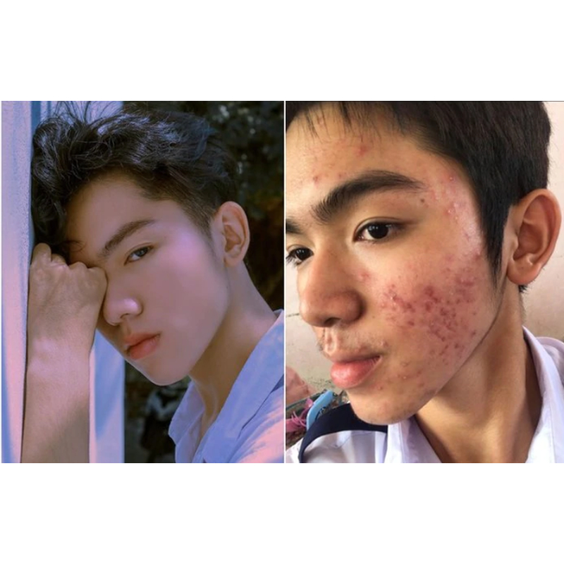 ZIO - Serum xoá mụn, nám , tàn nhang