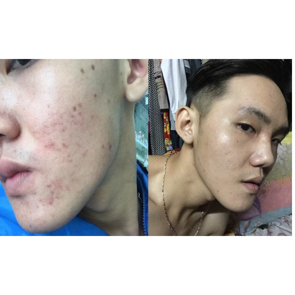 ZIO - Serum xoá mụn, nám , tàn nhang