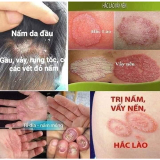 Tuýp bôi chống ngứa thảo mộc vàng phi tên lửa