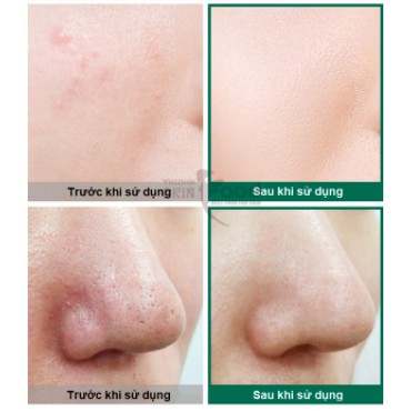 Nước Hoa Hồng Giảm Mụn Some By Mi AHA-BHA-PHA 30 Days Miracle Toner 150ml - Hàng Nhập Khẩu | BigBuy360 - bigbuy360.vn