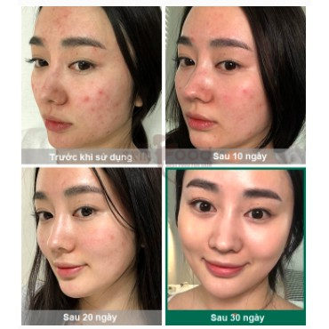 Nước Hoa Hồng Giảm Mụn Some By Mi AHA-BHA-PHA 30 Days Miracle Toner 150ml - Hàng Nhập Khẩu | BigBuy360 - bigbuy360.vn