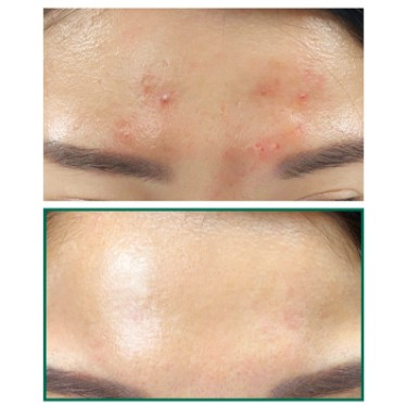 Nước Hoa Hồng Giảm Mụn Some By Mi AHA-BHA-PHA 30 Days Miracle Toner 150ml - Hàng Nhập Khẩu | BigBuy360 - bigbuy360.vn