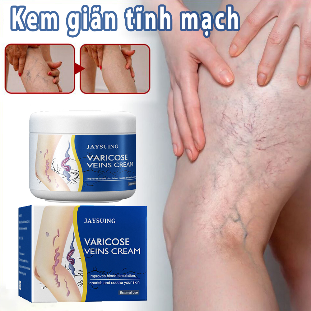 Kem suy giãn tĩnh 50g mạch giúp giảm đau mỏi, mất thẩm mỹ do suy giãn tĩnh mạch gây ra,Cải thiện lưu thông máu