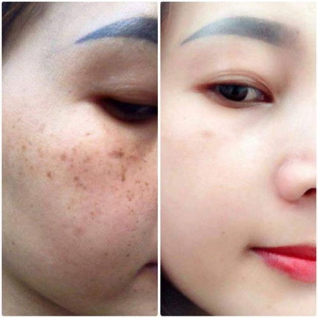 Mờ nám tàn nhang Achromin mờ nám tàn nhang chống lão hoá phục hồi da giảm nếp nhăn dưỡng trắng da