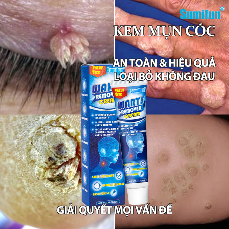 【Loại bỏ không đau】SUMIFUN 60G Thuốc bôi mụn cóc Thuốc trị mụn cóc Kem tẩy nốt ruồi Trị sùi mào gà
