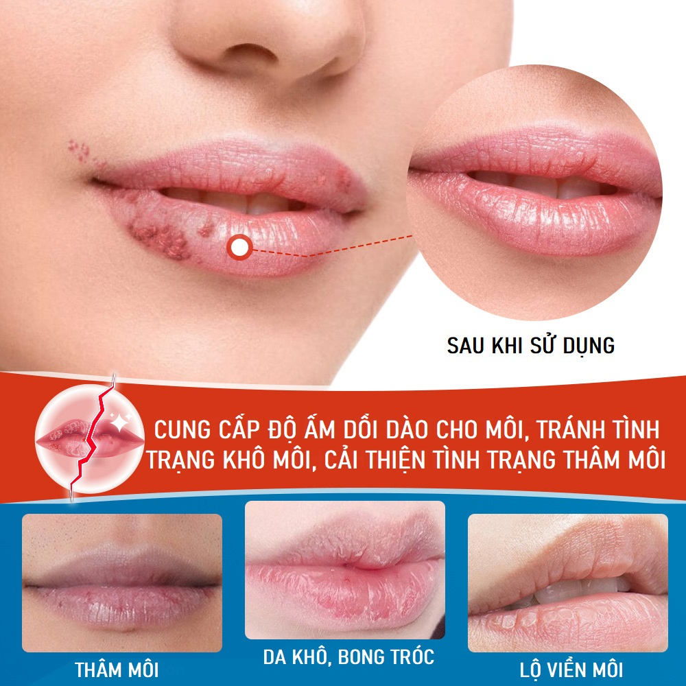 Kem Dưỡng Môi SUMIFUN Cheilitis Cream 20g, Giúp Dưỡng Ẩm Cho Môi, Cải Thiện Tình Trạng Khô, Nứt Nẻ, Giảm Thâm Sạm Môi